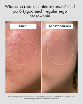 Toner do twarzy na trądzik z niacynamidem i kwasem azelainowym Anti-Acne Orphica Clinic 200 ml - 6