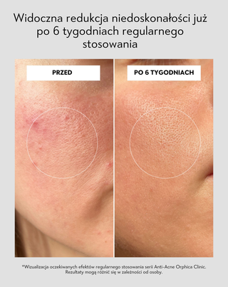 Przeciwtrądzikowy krem na dzień z kwasem salicylowym i azelainowym na niedoskonałości Anti-Acne Orphica Clinic 50 ml - 5
