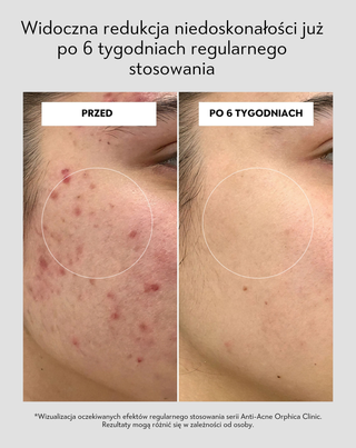 Peeling do twarzy do skóry trądzikowej z niacynamidem, pantenolem, BHA i mikrogranulkami Anti-Acne Orphica Clinic - 5